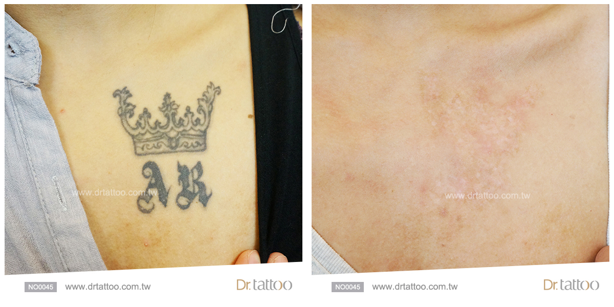 台北除刺青